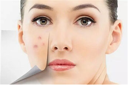 广州激光祛痘印要多少钱?