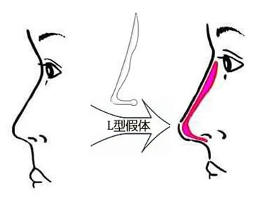 <a href='//m.roanokegop.com/www/sz/' target='_blank'><u>深圳美莱</u></a>假体隆鼻效果怎么样