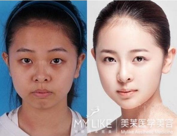 <a href='//m.roanokegop.com/www/gz/' target='_blank'><u>广州美莱</u></a>激光美白会有副作用吗