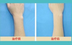 广州美莱激光脱臂毛价格是多少