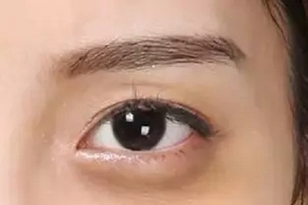 曲靖美莱激光去眼袋手术多少钱