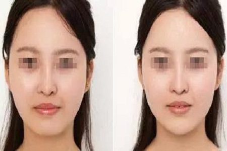 广州美莱垫下巴整形手术多少钱